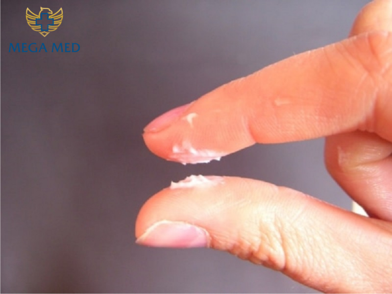 Xuất hiện bựa sinh dục do hẹp bao quy đầu